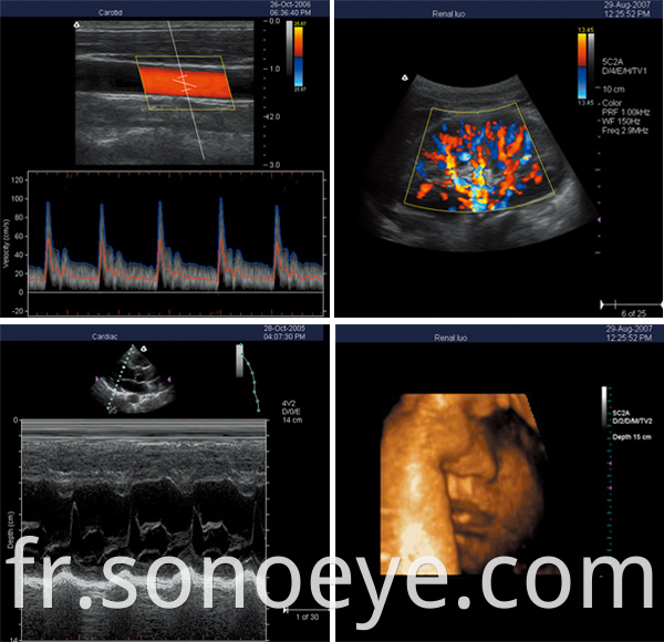 Trolley Type Ultrasound Scanner